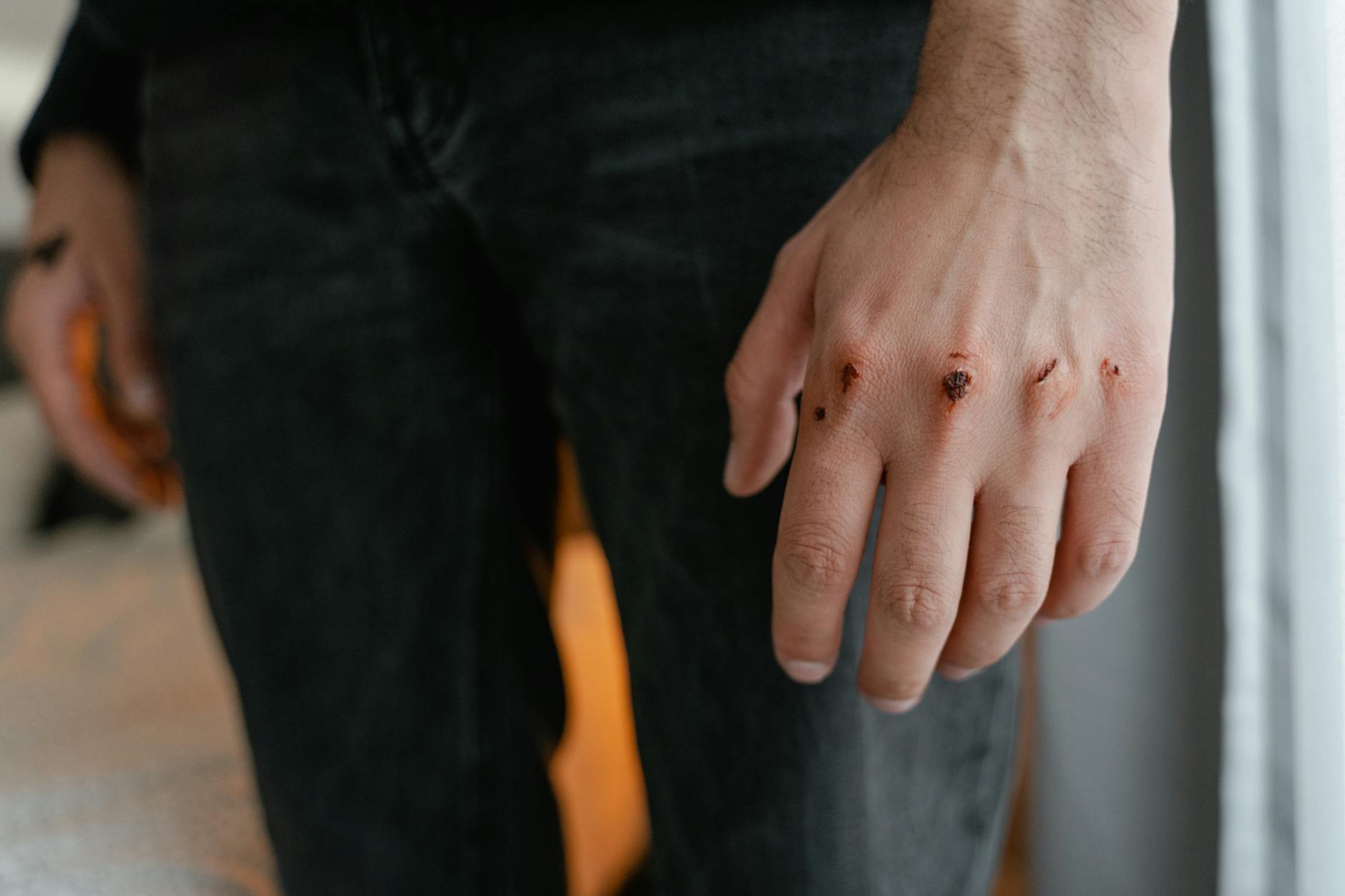 close up shot of wound on a person s hand